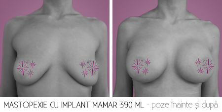 1cu implant
