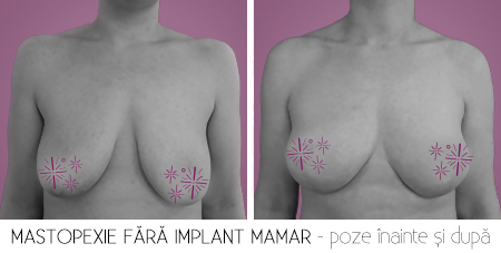1fara implant
