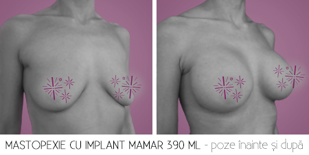 2cu implant