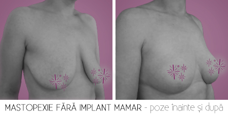 2fara implant