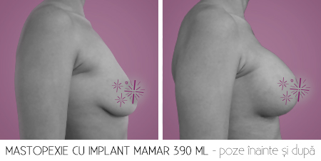 3cu implant