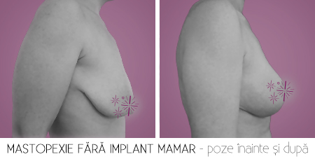3fara implant